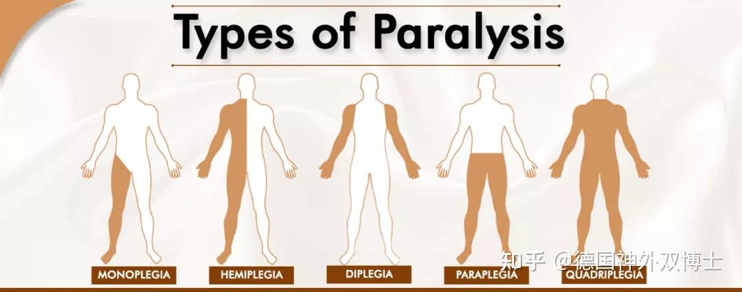 Flaccid Paralysis Meaning