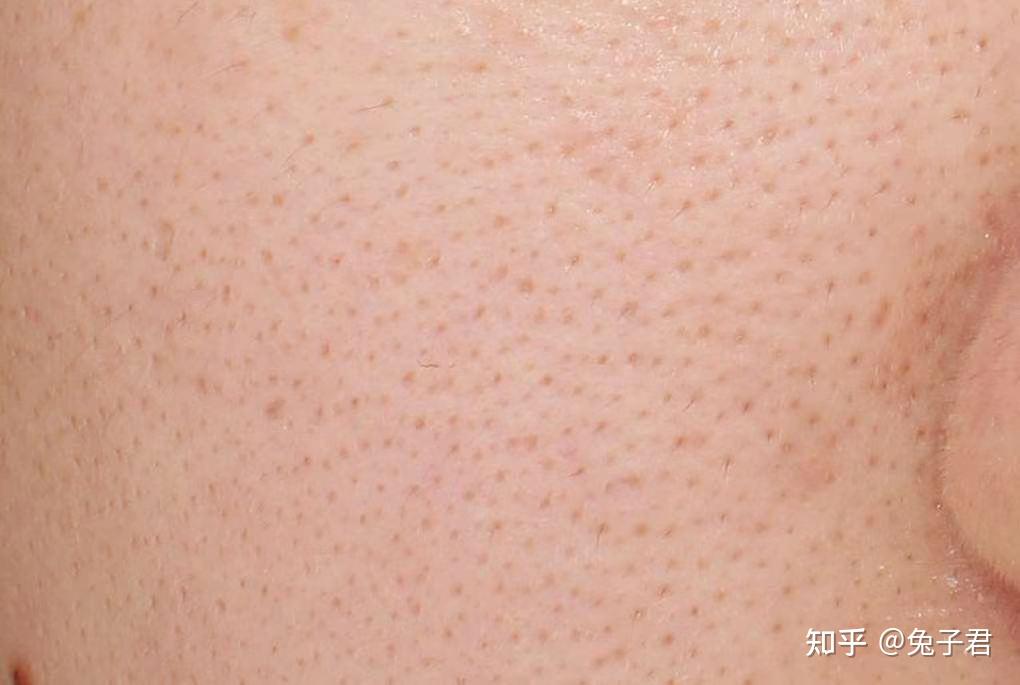 毛孔粗大的男生是如何把肤质变好的?