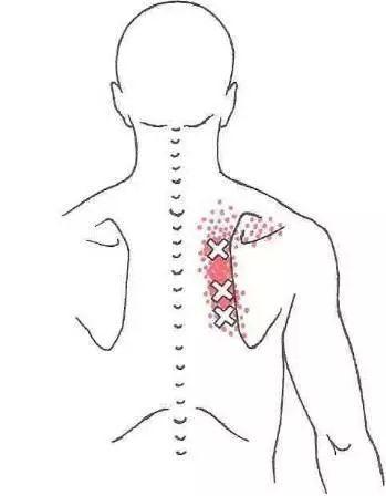 肩胛骨筋膜炎的症状图图片