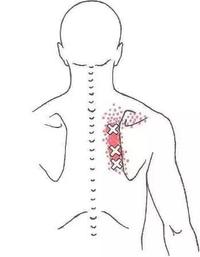 肩胛骨周圍疼痛的7個可能原因
