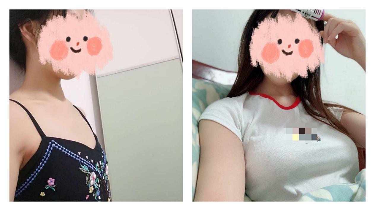 广州哪些医院医生做的隆胸比较好假体隆胸和自体脂肪隆胸