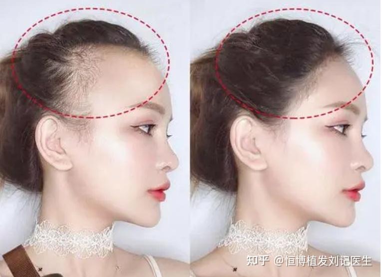 头发两边少中间多 - 知乎