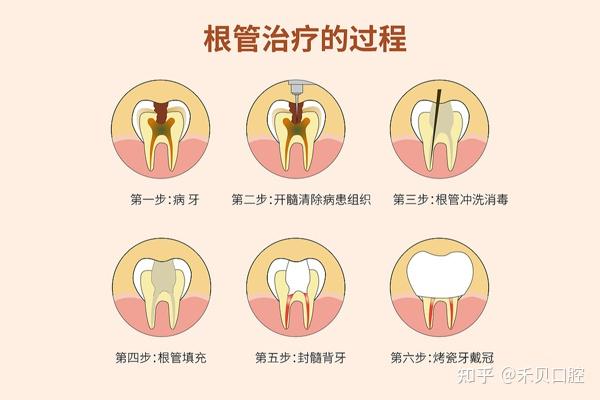 根管治疗与盖髓术的区别!! - 知乎