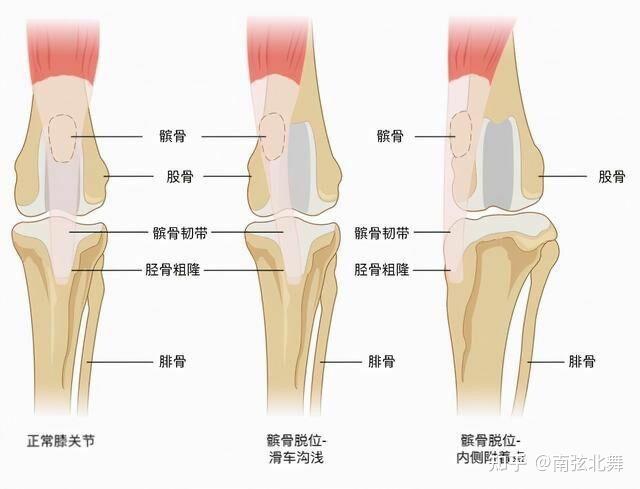 左髌骨位置图片