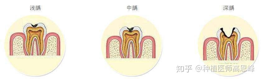 為什麼就我容易有齲齒? - 知乎