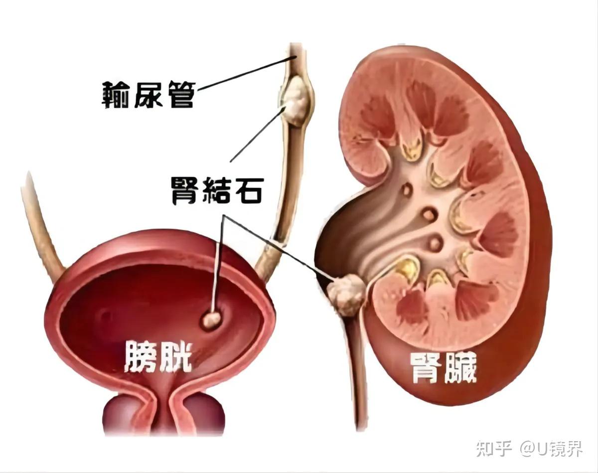 尿结石位置图片图片