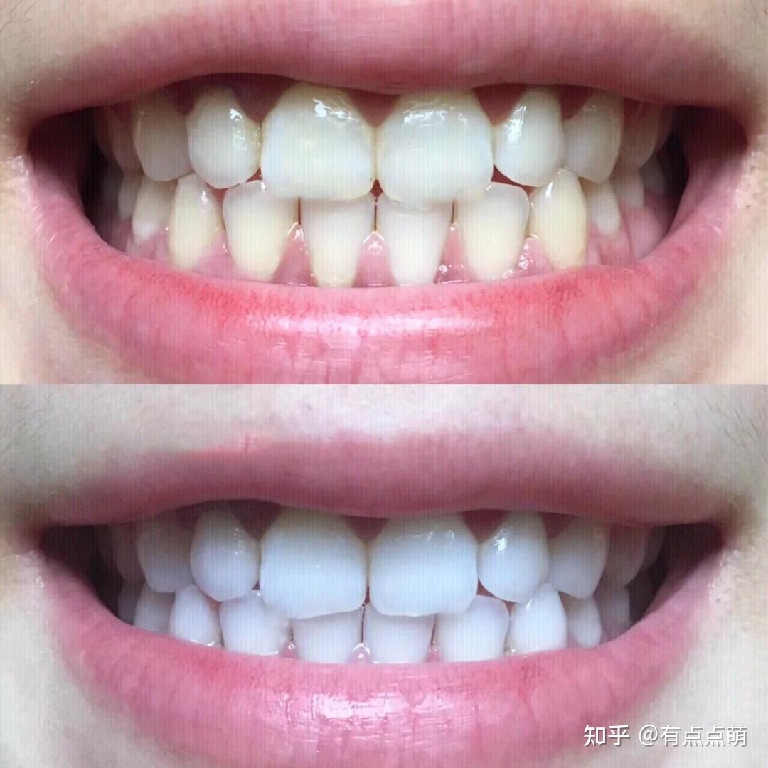 怎么让牙齿变白黄牙多年怎么办