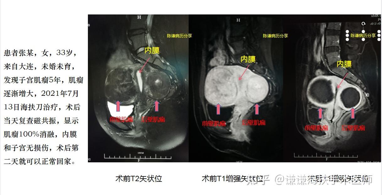 陈谦主任多发性子宫肌瘤海扶刀治疗病例分享