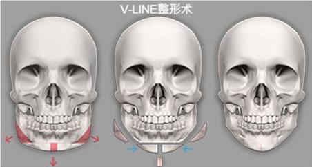 科普vline瓜子脸大脸方脸适用