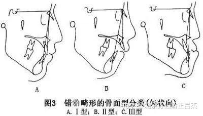 正畸中骨性面型的分类 知乎