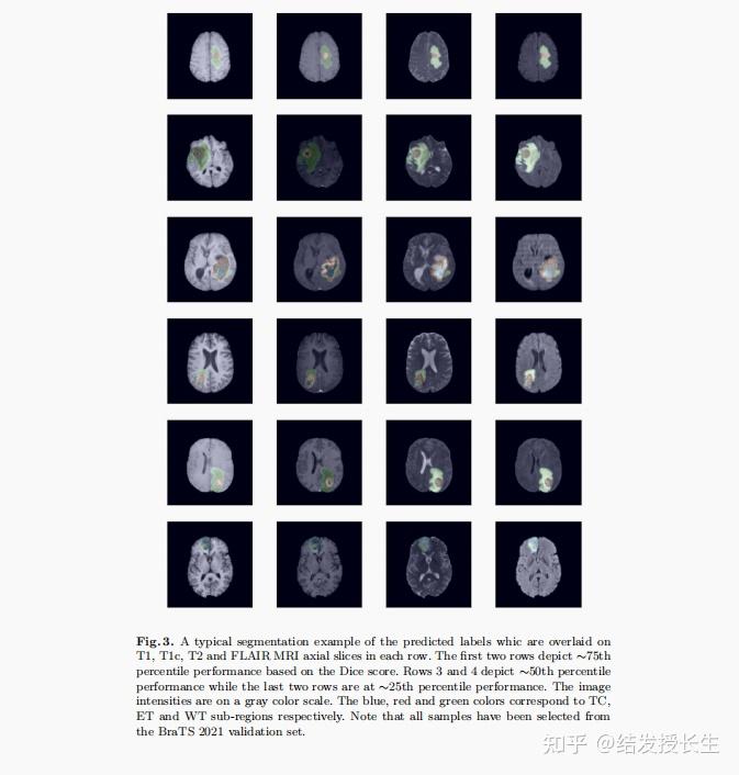  transformer swin unetr swin transformers for semantic segmentation of