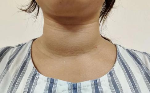 甲状腺结节照片图片