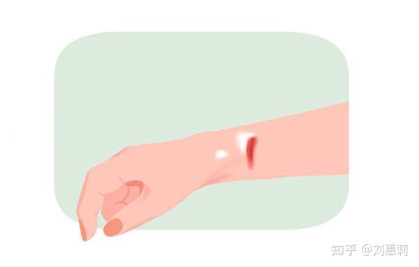 皮肤外伤诱发白癜风怎么办?记住这几点教你避坑~ - 知乎