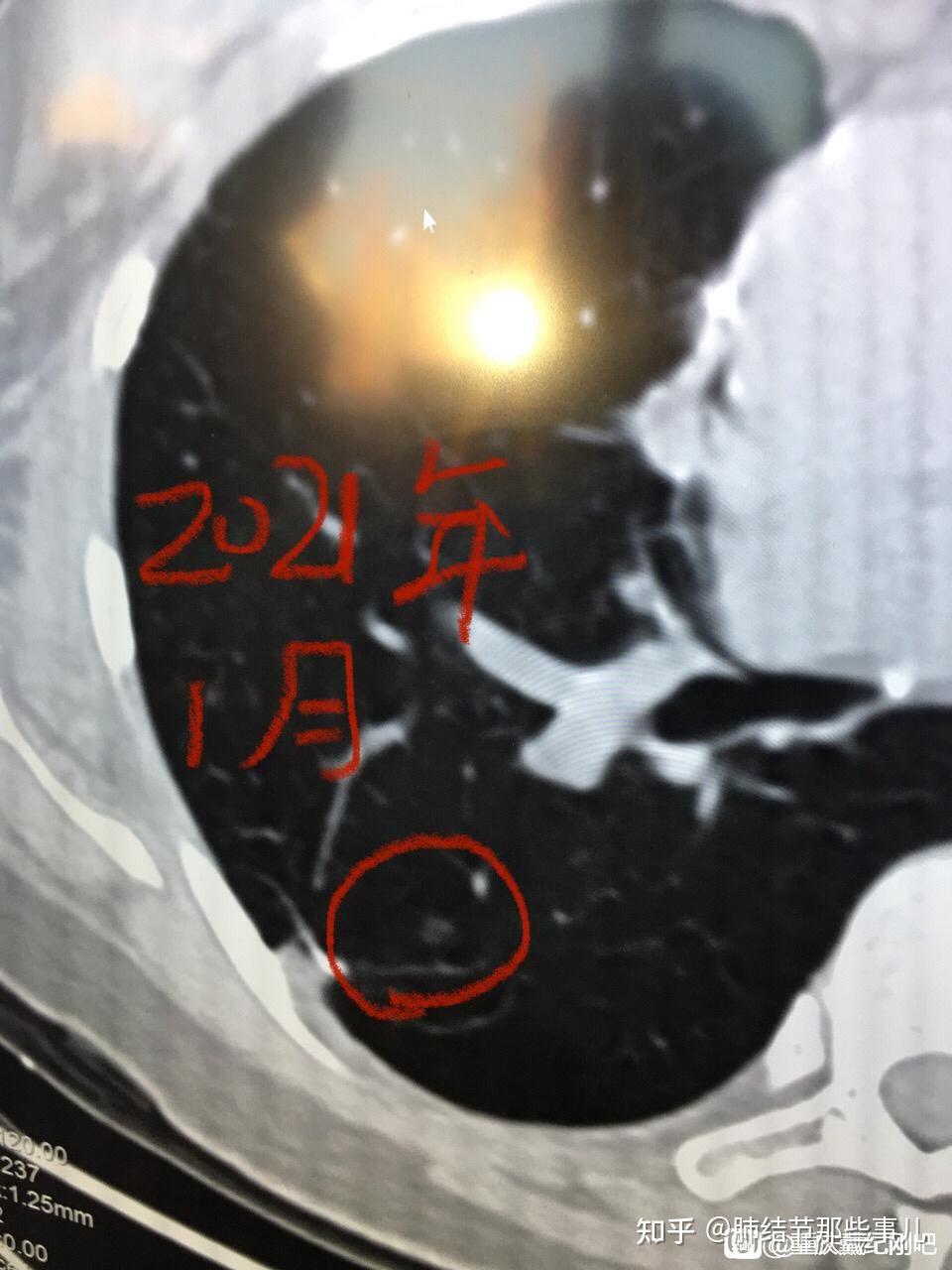 肺癌手術後又發現磨玻璃結節怎麼辦先彆著急夢碎那都是術前漏診的