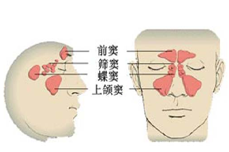 首大陈潜如何防治急性鼻窦炎