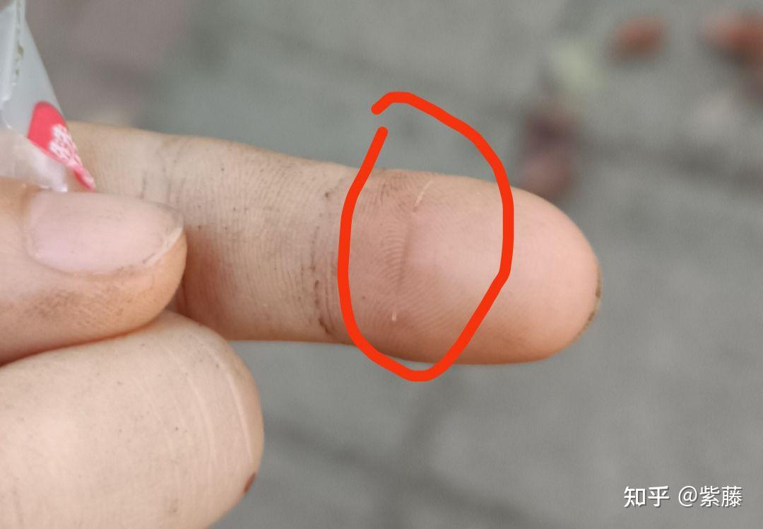 娃指腹扎入竹刺后 - 知乎