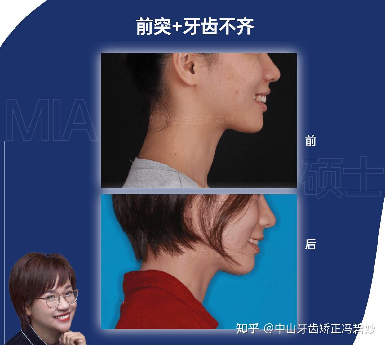 #中山牙齿矫正#中山整牙|面部微笑美学之笑线。 - 知乎