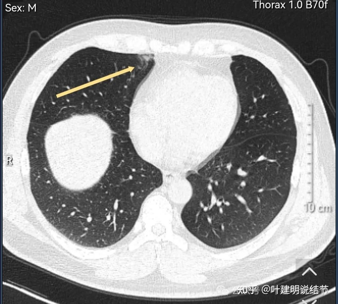 右侧心膈角区在哪里图片