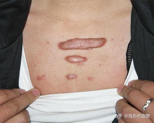 日本小川令疤痕贴保守修复疤痕增生性疤痕蟹足肿