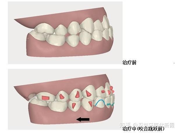 "地包天"存在下颌前突上颌后缩问题,导致面中部凹陷,形成"新月脸"