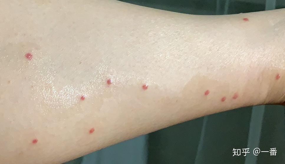 抗击丘疹性寻麻疹的日子(已痊愈) - 知乎