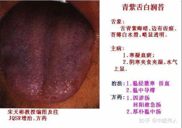 高清舌诊图解:各种临床证型舌象图谱大开眼界 - 知乎