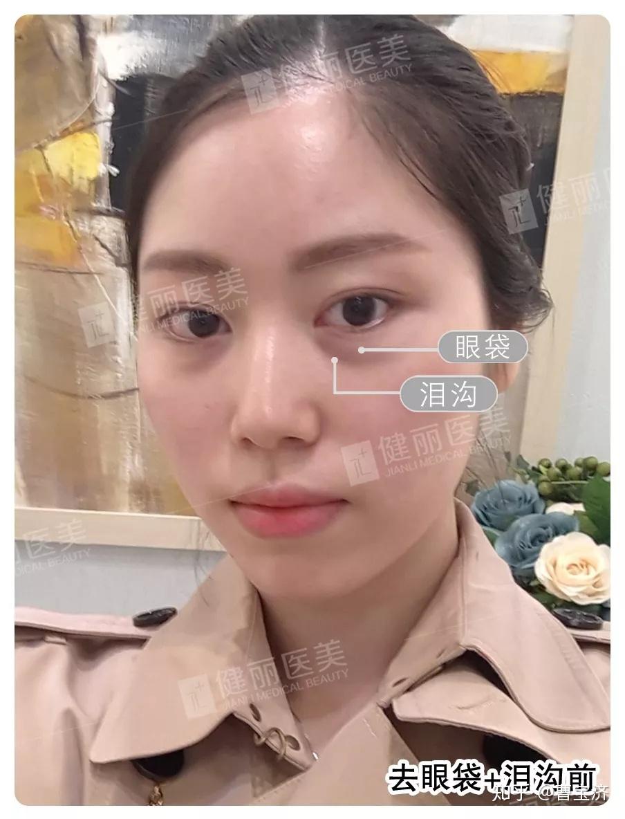 填充脂肪能泪沟消肿吗_脂肪能填充泪沟吗_填充脂肪能泪沟去除吗