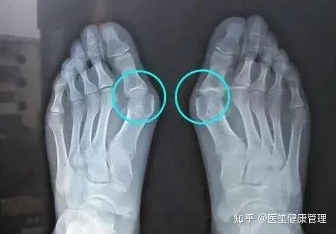 怎样确定自己是拇囊炎？拇囊炎要如何治疗？ - 知乎