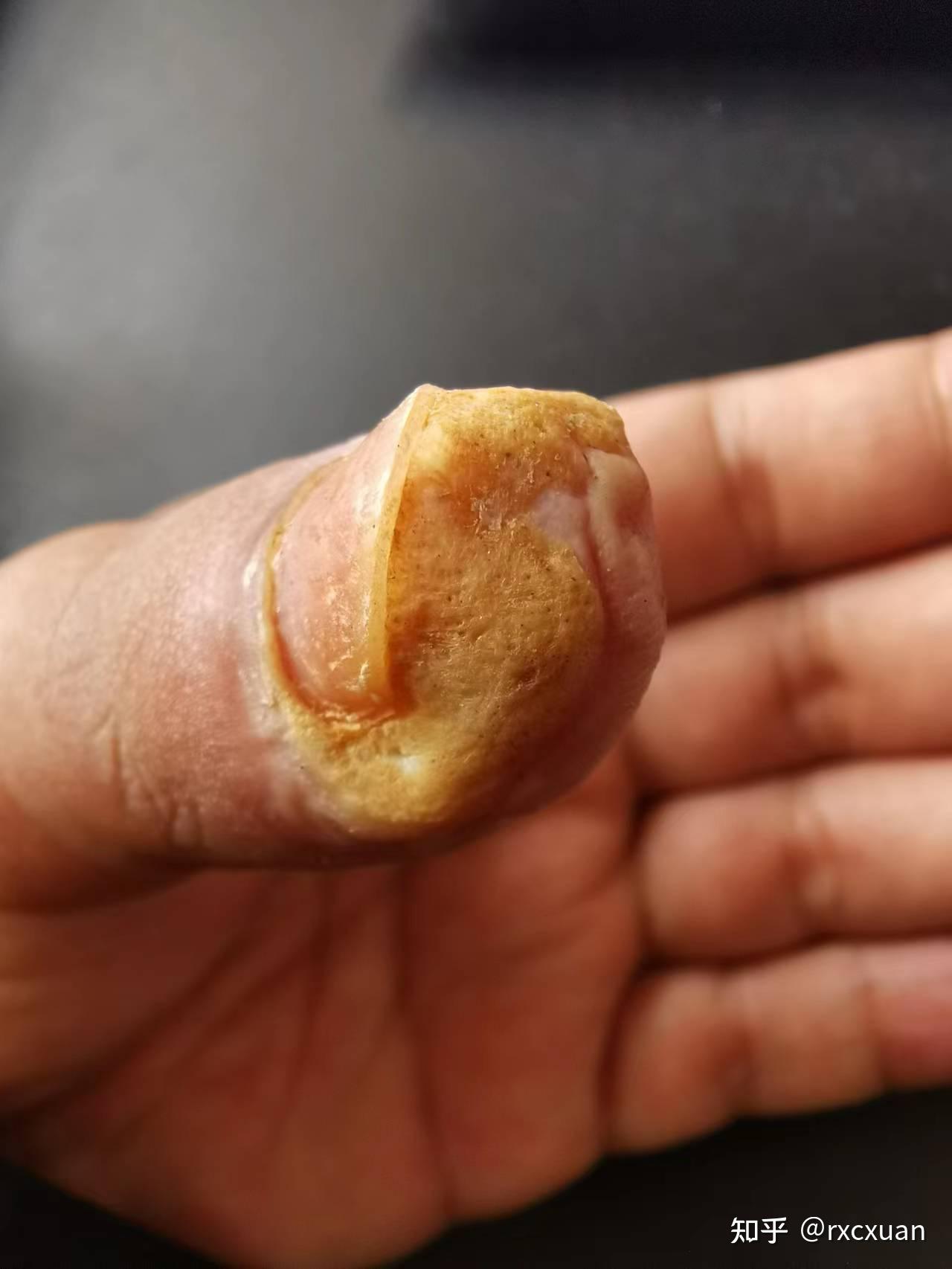 2年甲周疣治疗经过现在好了