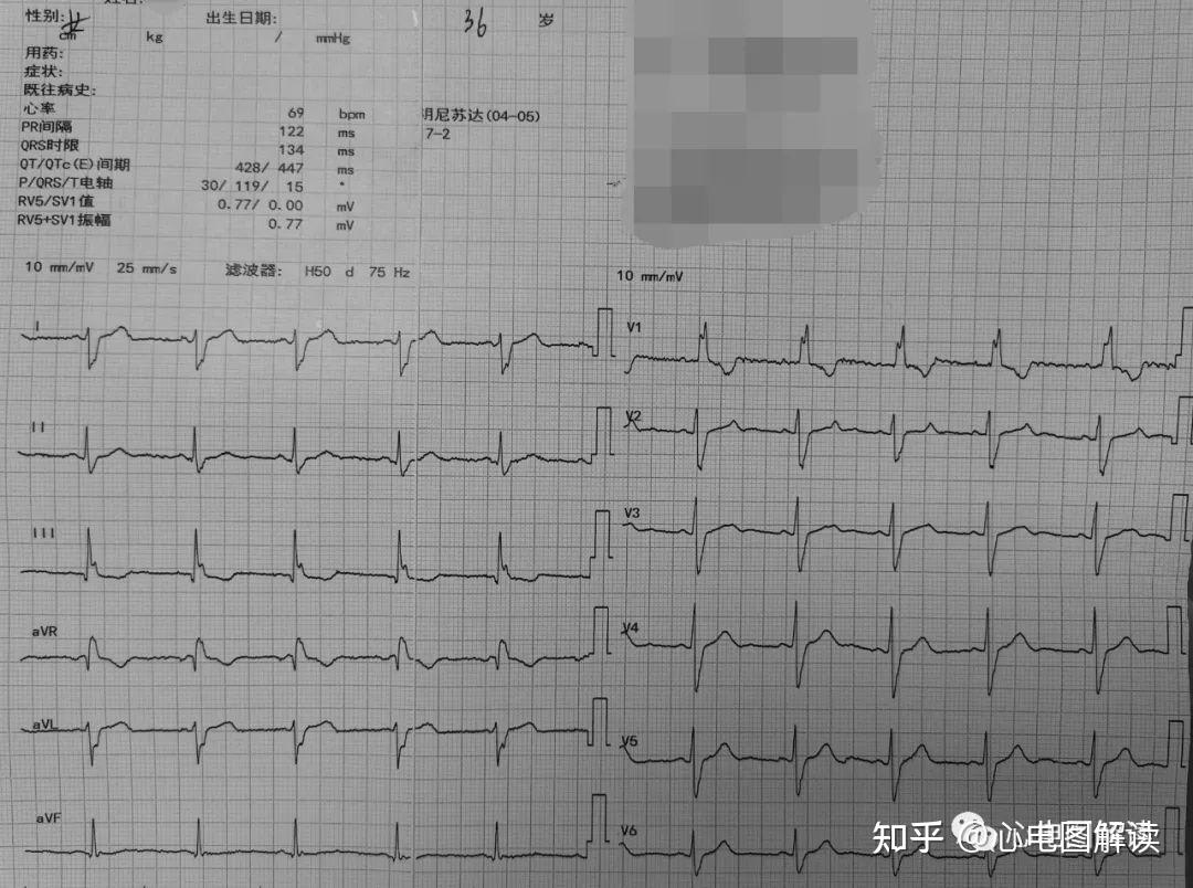 今天要分享的心電圖
