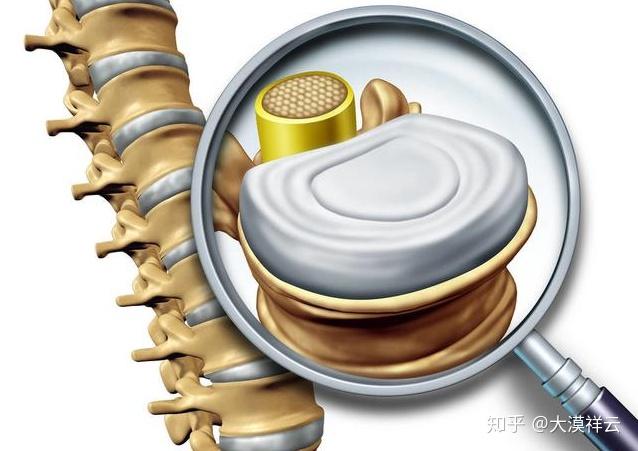 腰椎間盤突出壓迫坐骨神經痛腰間盤突出治療動作片