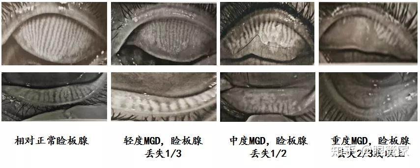 缓解睑板腺导致的干眼,需要恢复睑板腺的功能,促进睑板腺的油脂分泌才