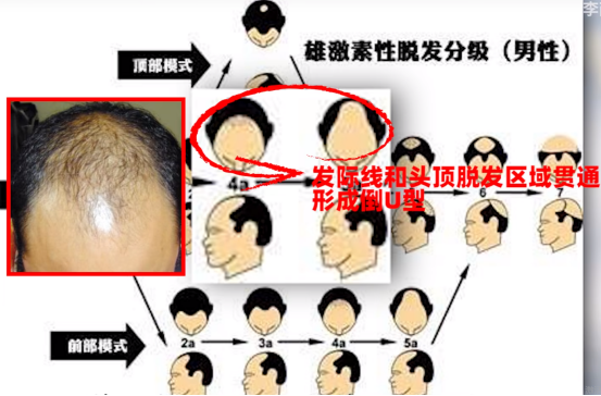 发际线高只能植发吗?科普篇 - 知乎