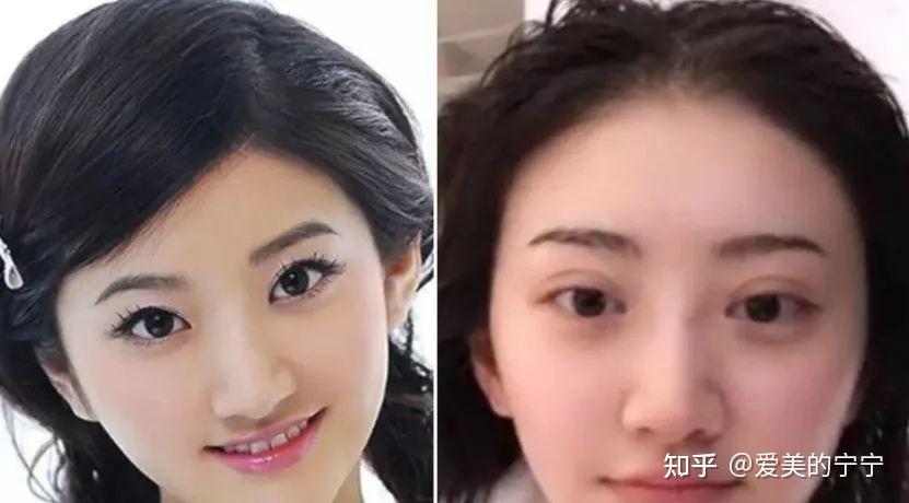 双眼皮别乱割从戚薇到景甜这4位明星的后遗症出来了