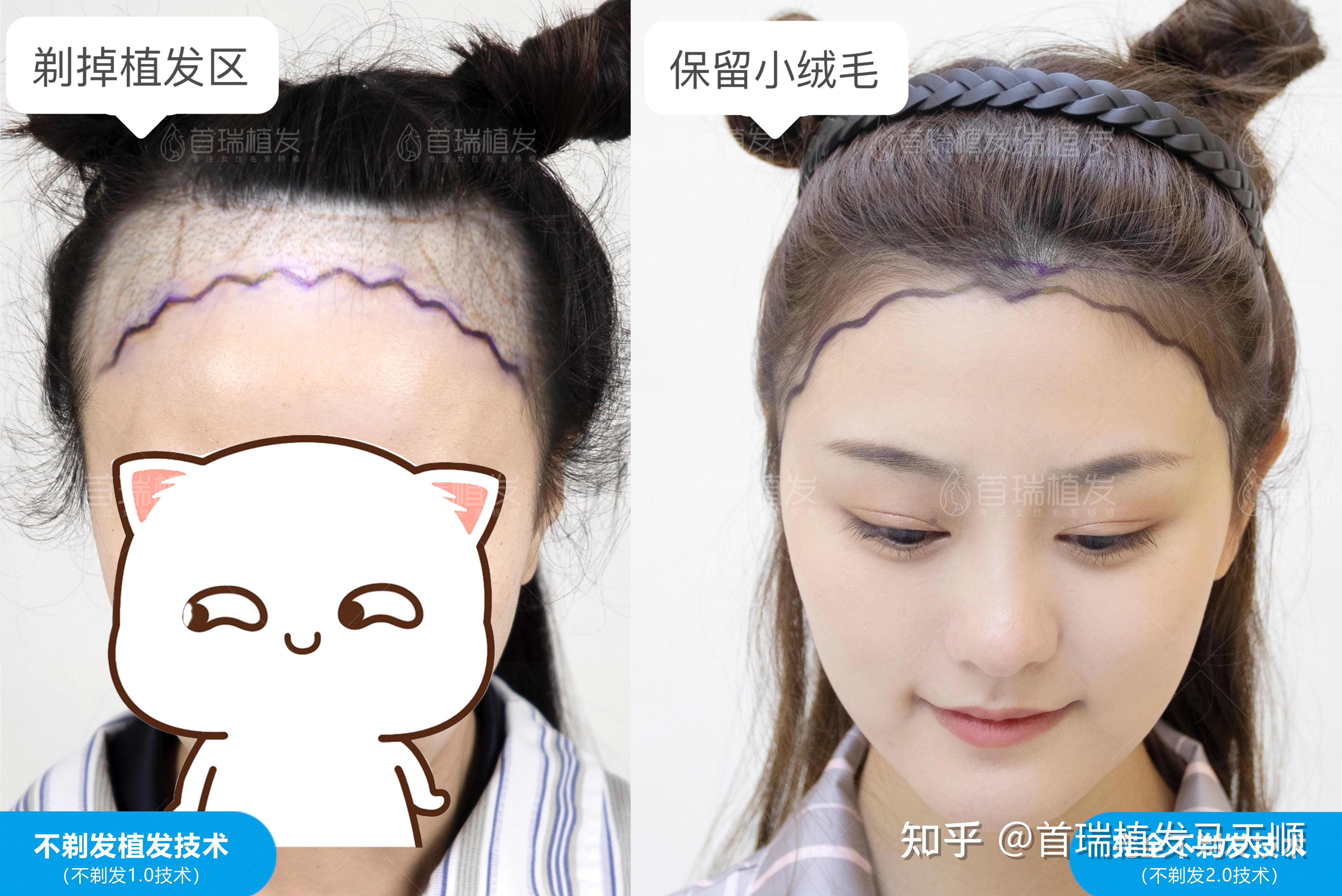 植发一定要剃头发？完全不剃发如何做到“一根头发不剃”......