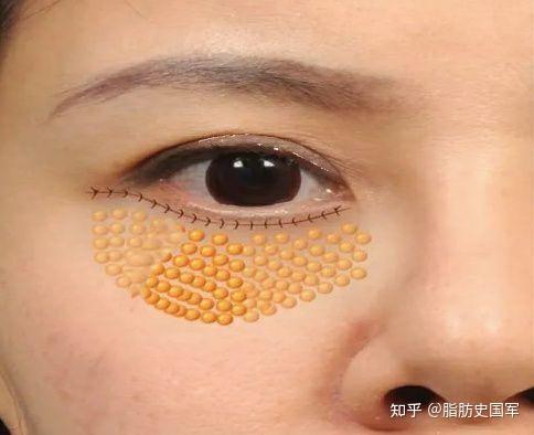 脂肪移植,眼袋手术的必要操作