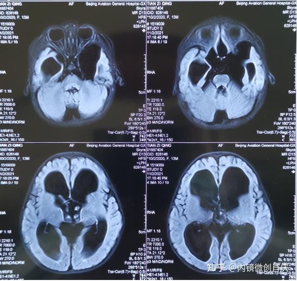 鞍上池囊肿合并双侧颞极蛛网膜囊肿相关性脑积水案例分享