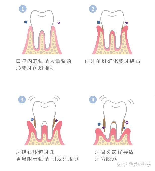 为何年纪轻轻,牙齿却早早离家出走? - 知乎