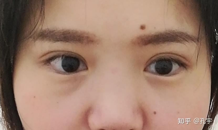 处理下睑倒睫)3,眼睑臃肿  2,眼睑皮肤松弛  1,双眼上睑下垂(不对称)