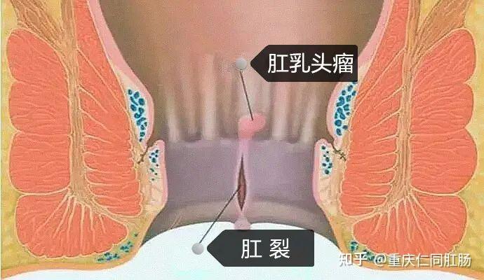 肛裂赘生物图片图片