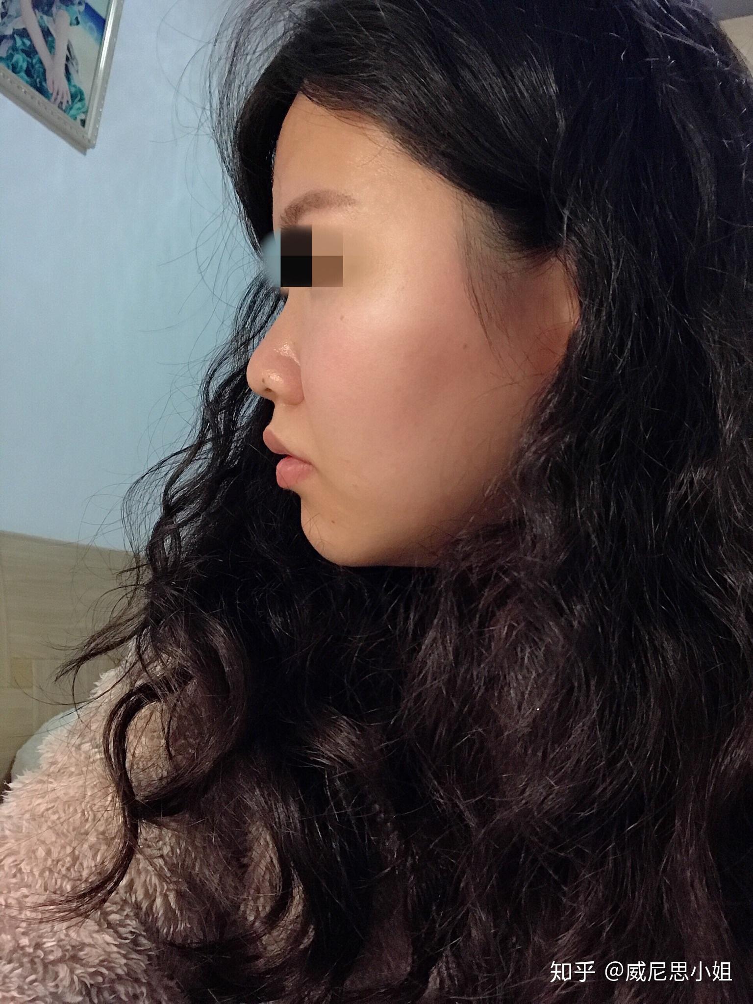 矫正完后牙齿侧面看龅牙,而且嘴秃了.