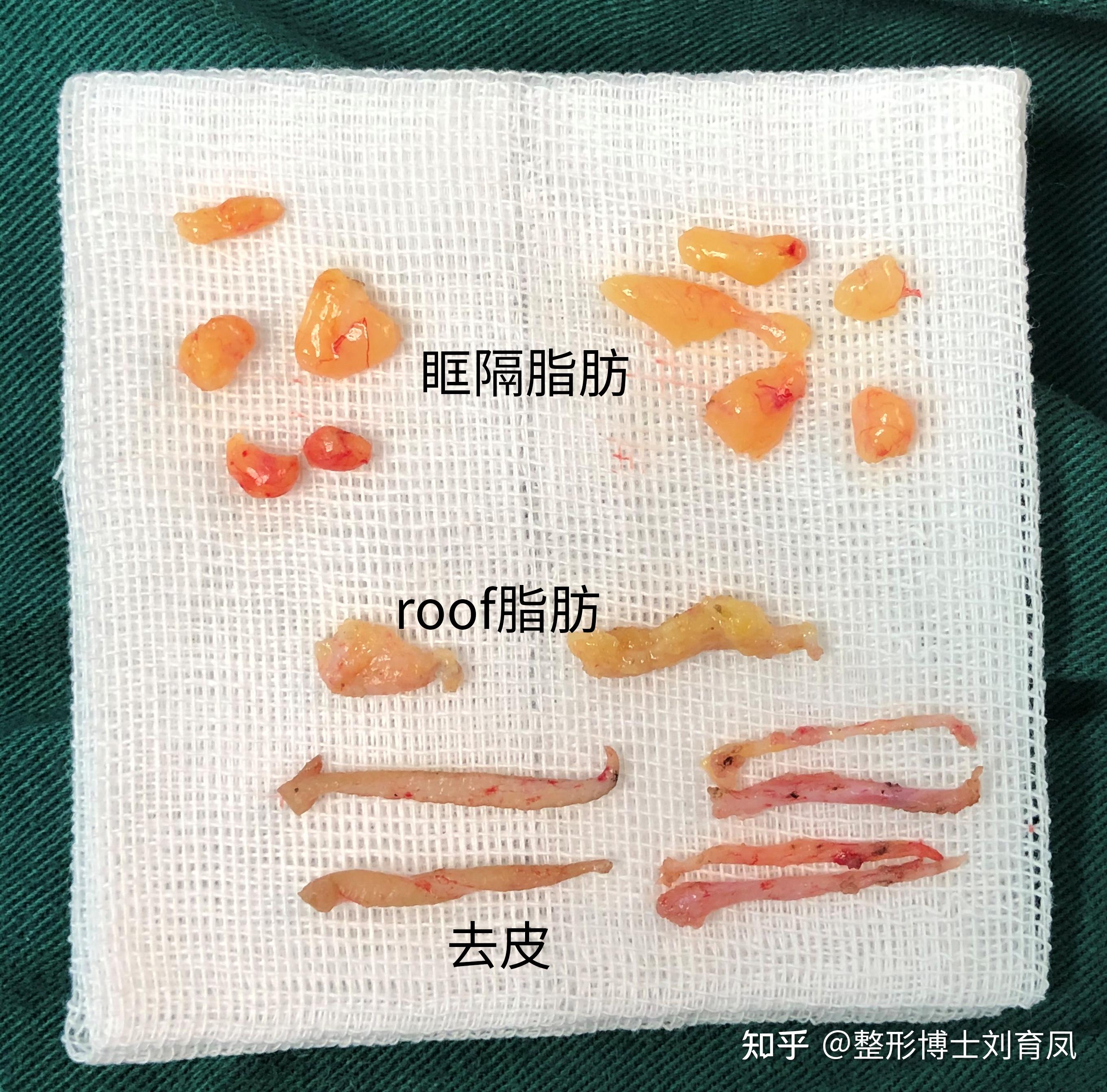 上睑脂肪包括眶膈后脂肪(眶脂)和眼轮匝肌后脂肪(英文缩写为roof)眼轮