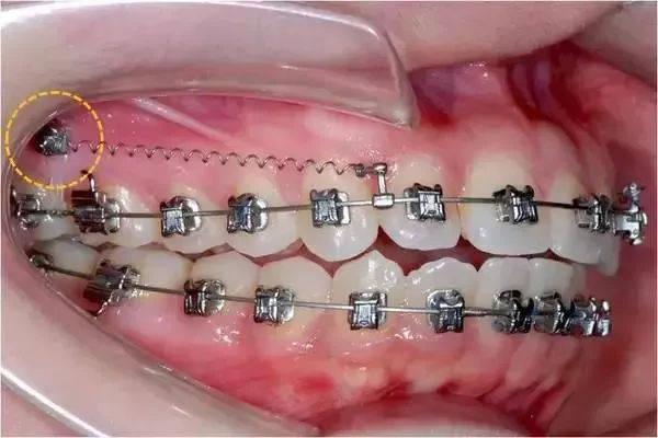 正畸中的支抗钉是个啥?