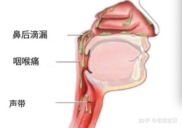 部和/或咽後壁,使小朋友的