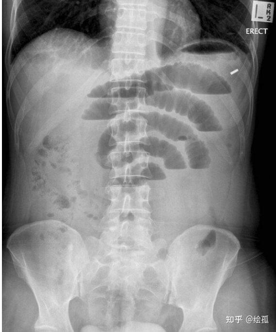 并有腹胀,腹痛等临床表现时,统称为肠梗阻 (intestinal obstruction)