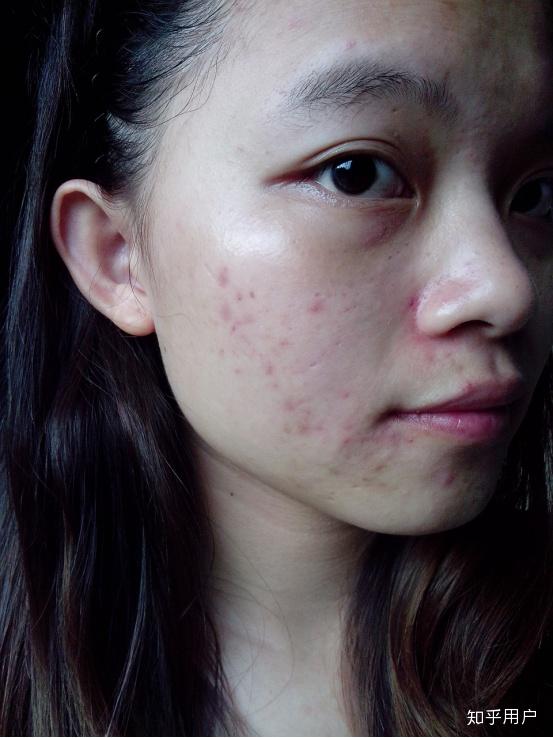 男生会不会喜欢脸上有痘印或痘痘的女孩子