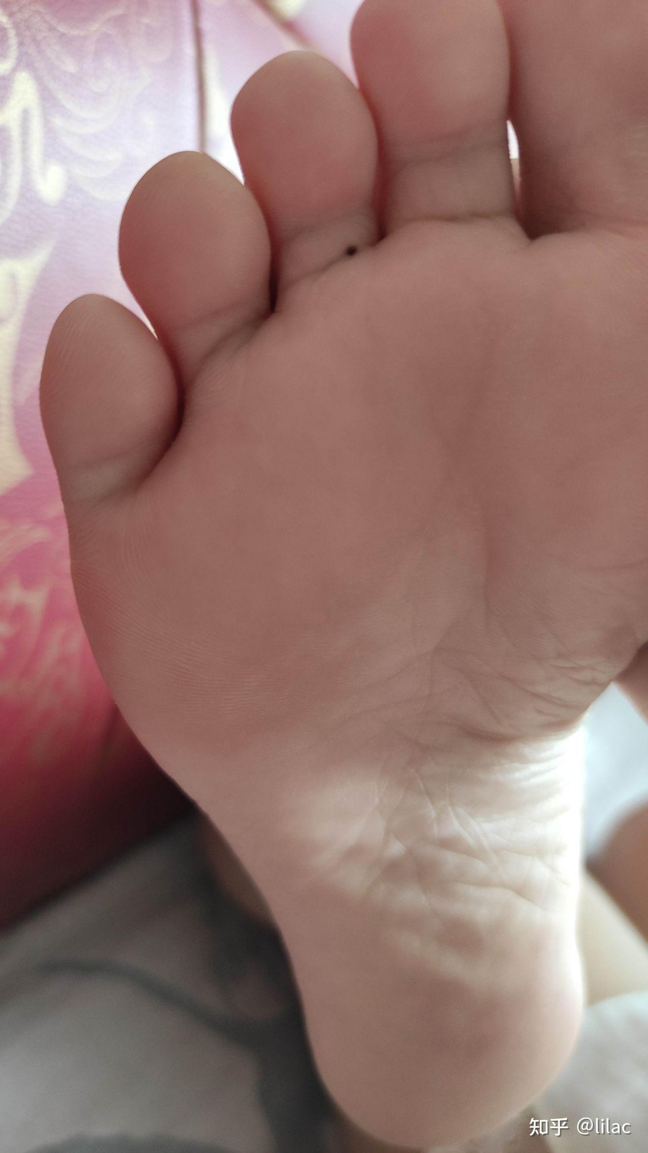 右脚第三脚趾下有颗痣,影响健康吗? 