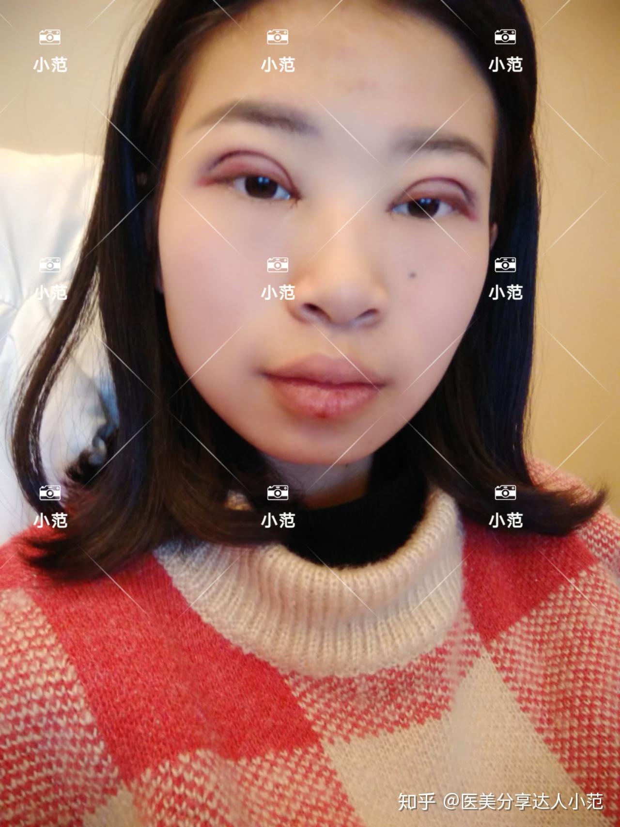 本人双眼皮术后第一天