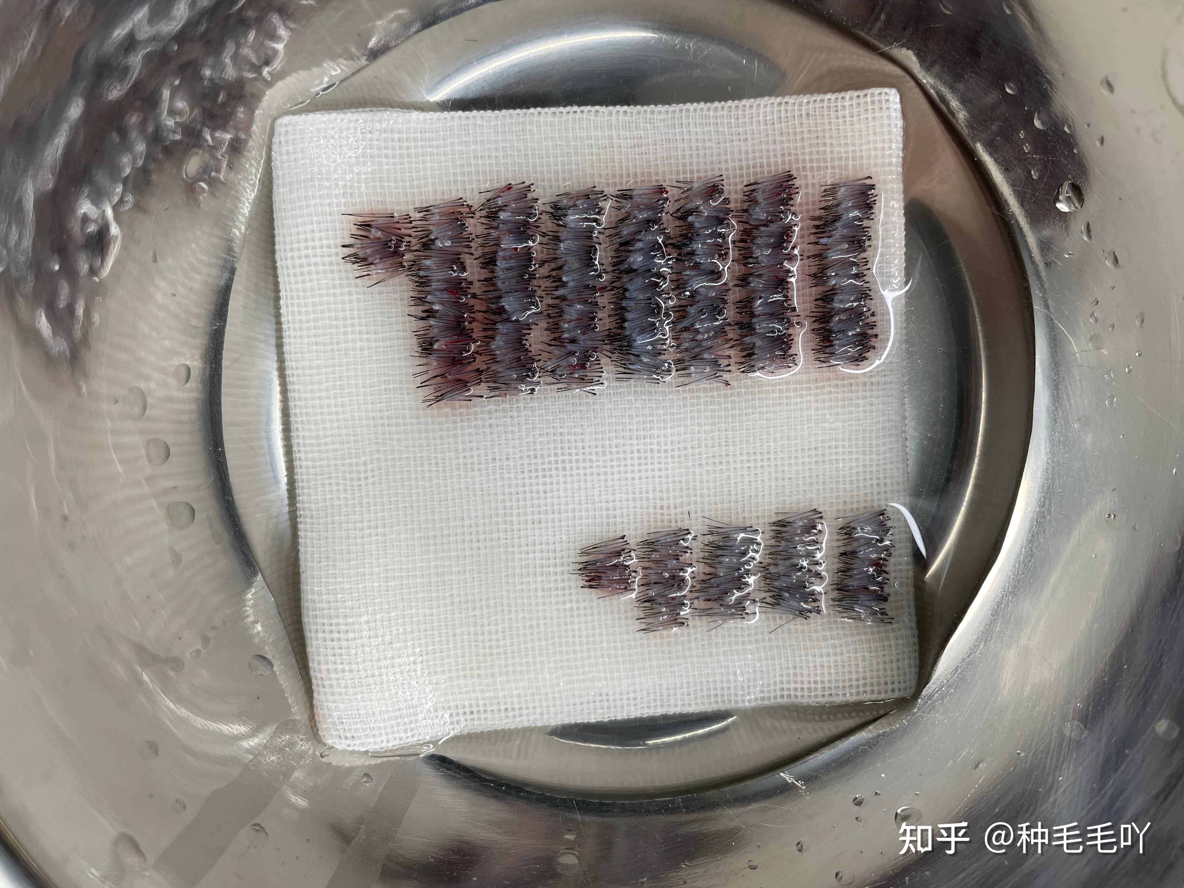 异毛植发(异体头发种植)