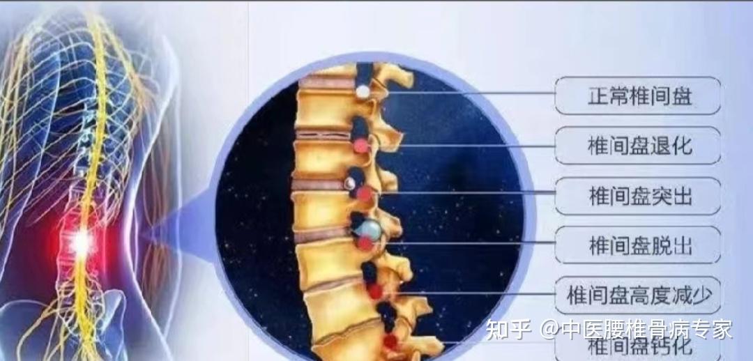 什么是腰椎椎体终板炎,手术能解决吗? - 知乎